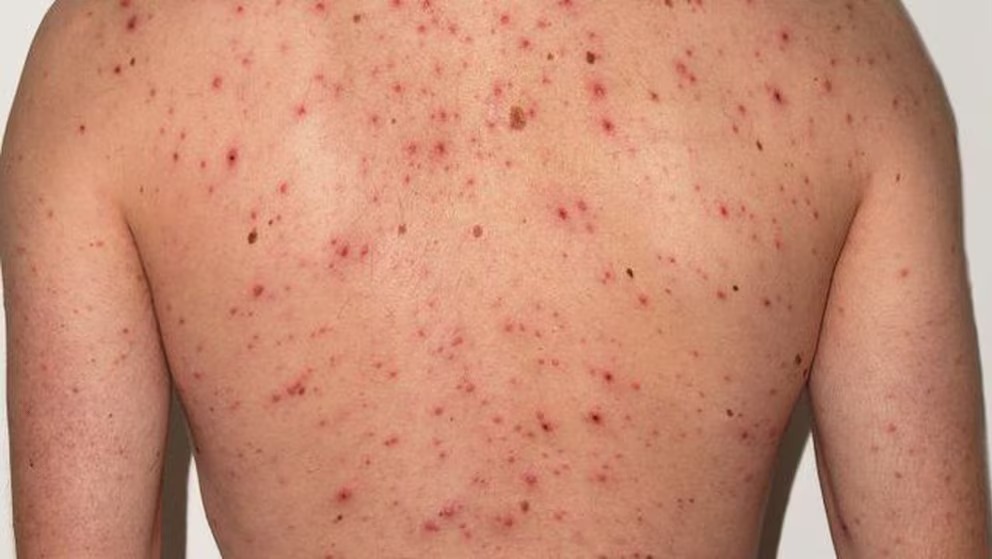 En Colón SESAL mantiene bajo estricta vigilancia por sospecha de Sarampión a persona   que parti...