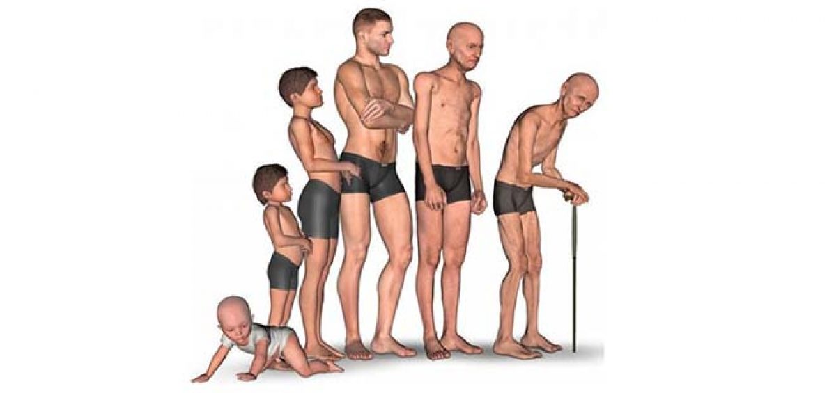 La Sarcopenia es la pérdida de masa muscular y fuerza esquelética como resultado del envejecimiento