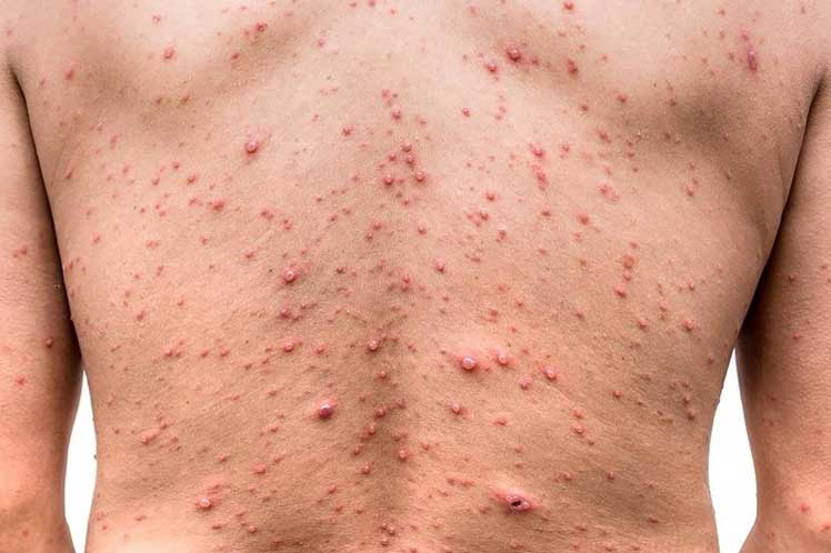 Salud pide mantener medidas de bioseguridad ante el nuevo reporte de Viruela Símica